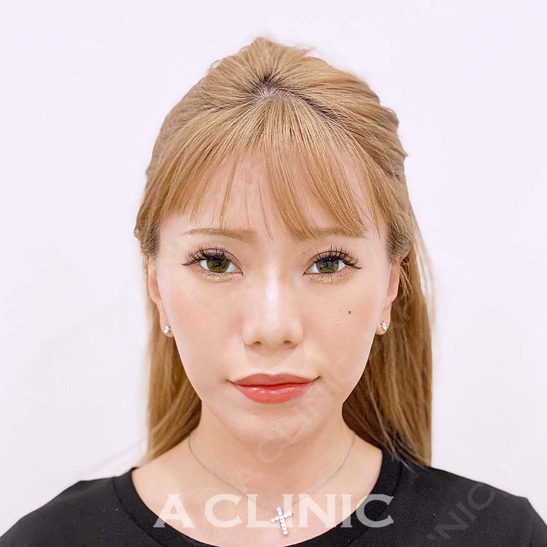 Aスレッドは当日から腫れの少ない小顔術です！処置前と処置直後です(20代女性) AFTER