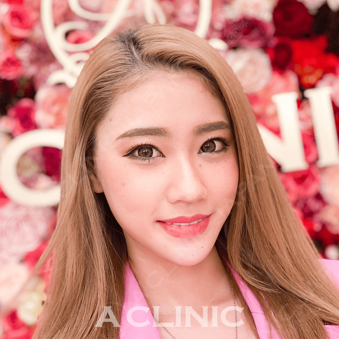 Aスレッドでスッキリ小顔に！処置前と処置直後の症例です(20代女性) AFTER