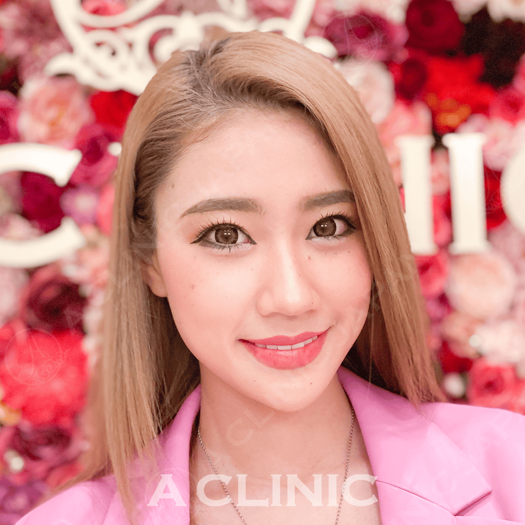 Aスレッドでスッキリ小顔に！処置前と処置直後の症例です(20代女性) BEFORE