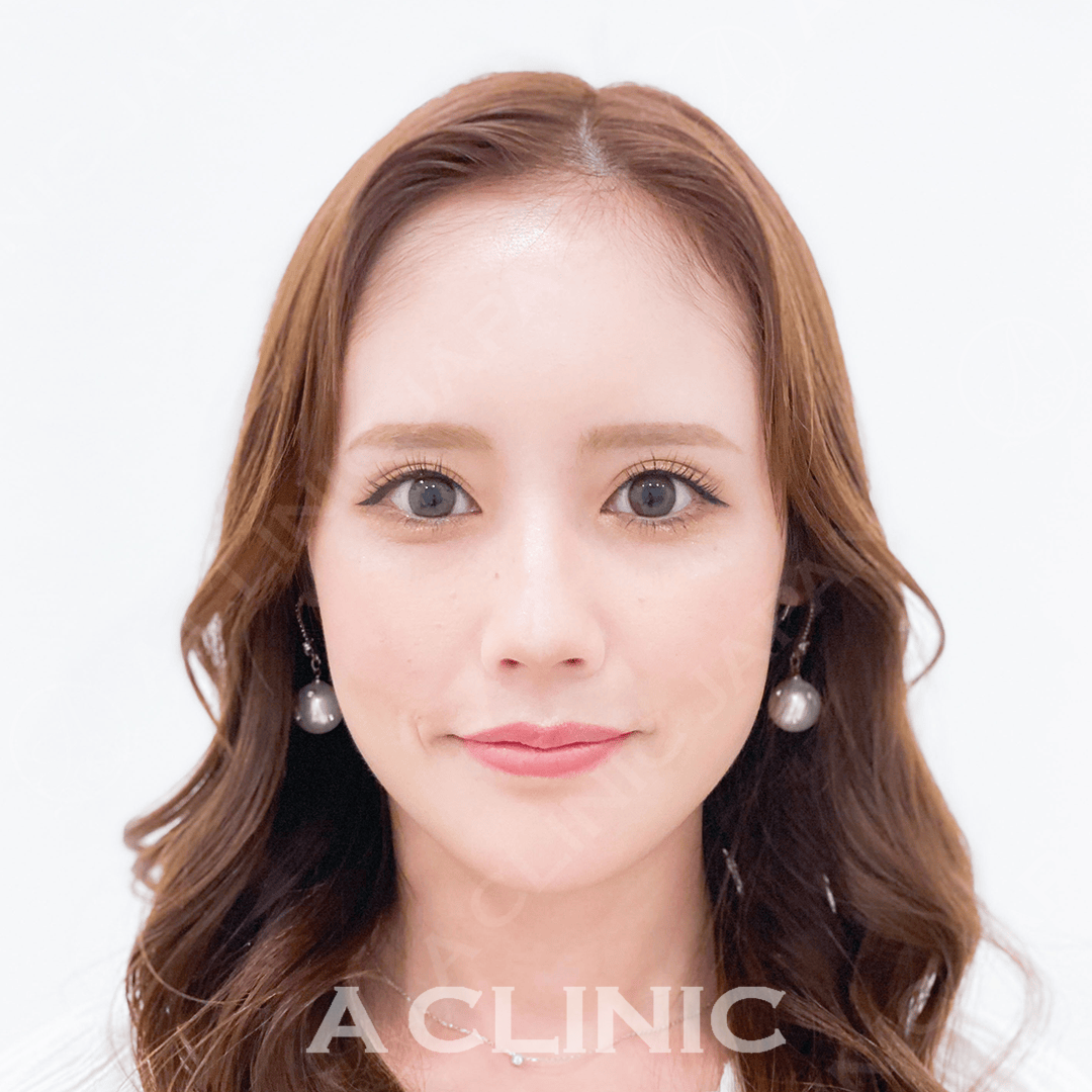 しわ、たるみの予防にも！Aスレッド施術前、施術直後の症例です(20代女性) BEFORE