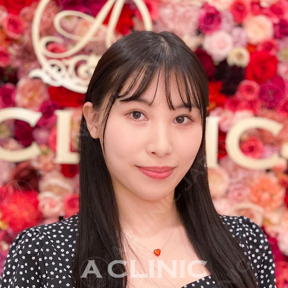 輪郭の脂肪やたるみのお悩みが即日解消！Aスレッドの処置前と処置直後の症例です(20代女性) AFTER