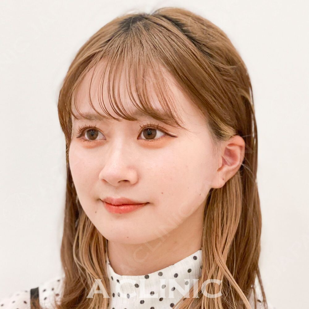 Aスレッドで引き締まった小顔美人に！処置前と処置直後の症例です(20代女性) AFTER