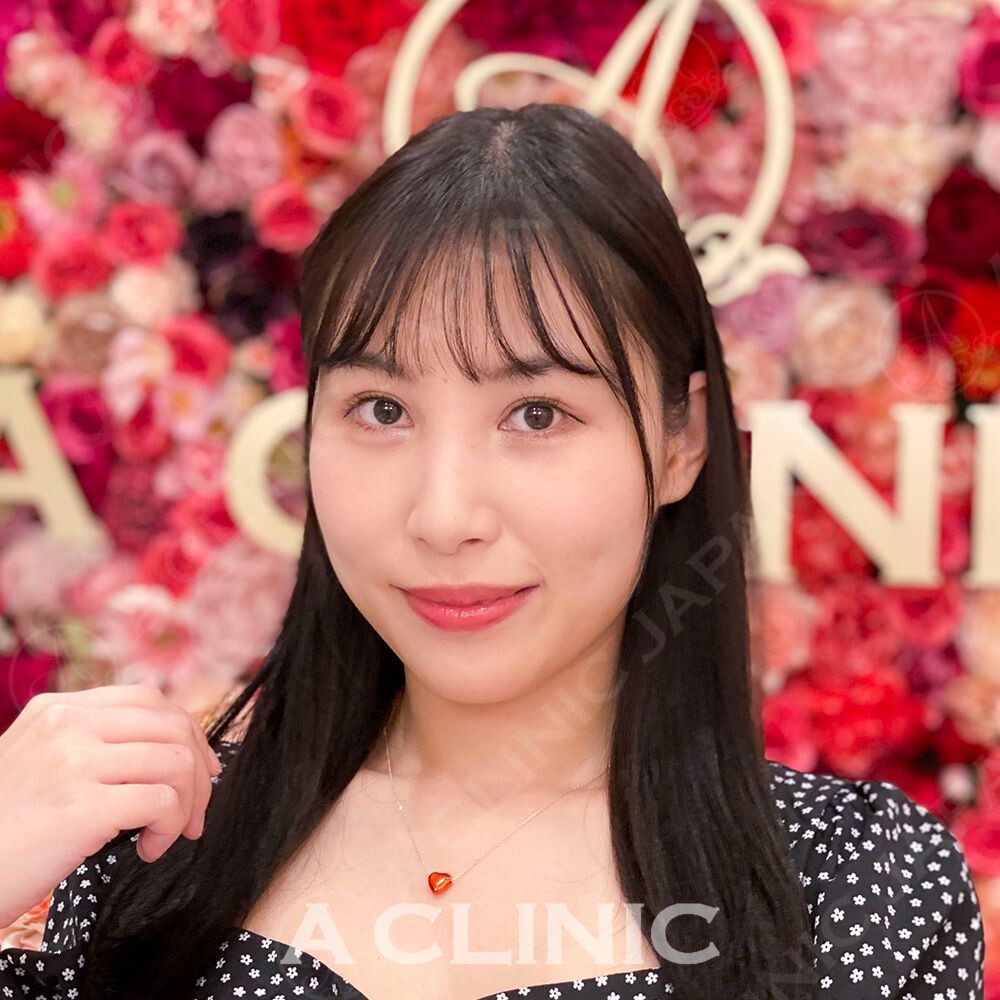 輪郭の脂肪やたるみのお悩みが即日解消！Aスレッドの処置前と処置直後の症例です(20代女性) BEFORE