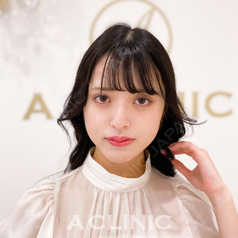 小顔になるだけで美人度が倍増します！Aスレッドの処置前と処置直後の症例です(20代女性) BEFORE