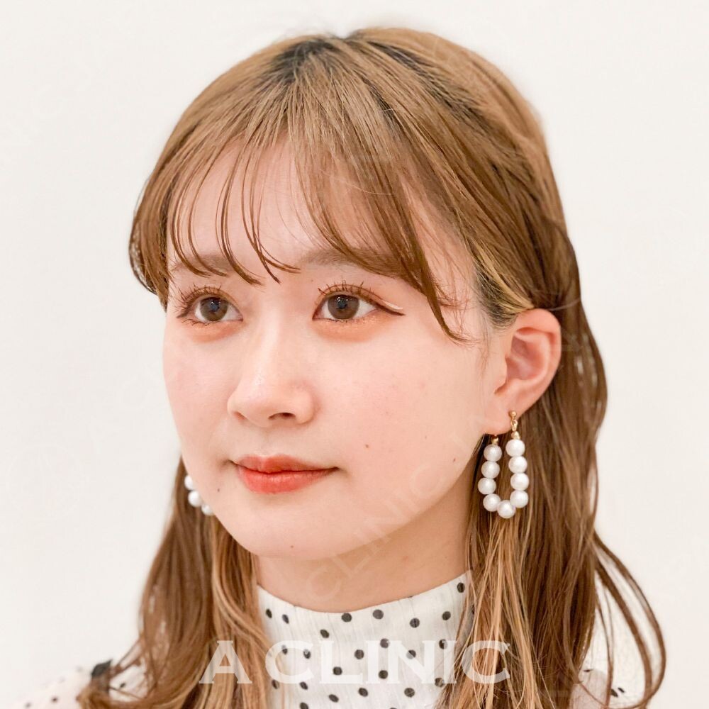 Aスレッドで引き締まった小顔美人に！処置前と処置直後の症例です(20代女性) BEFORE