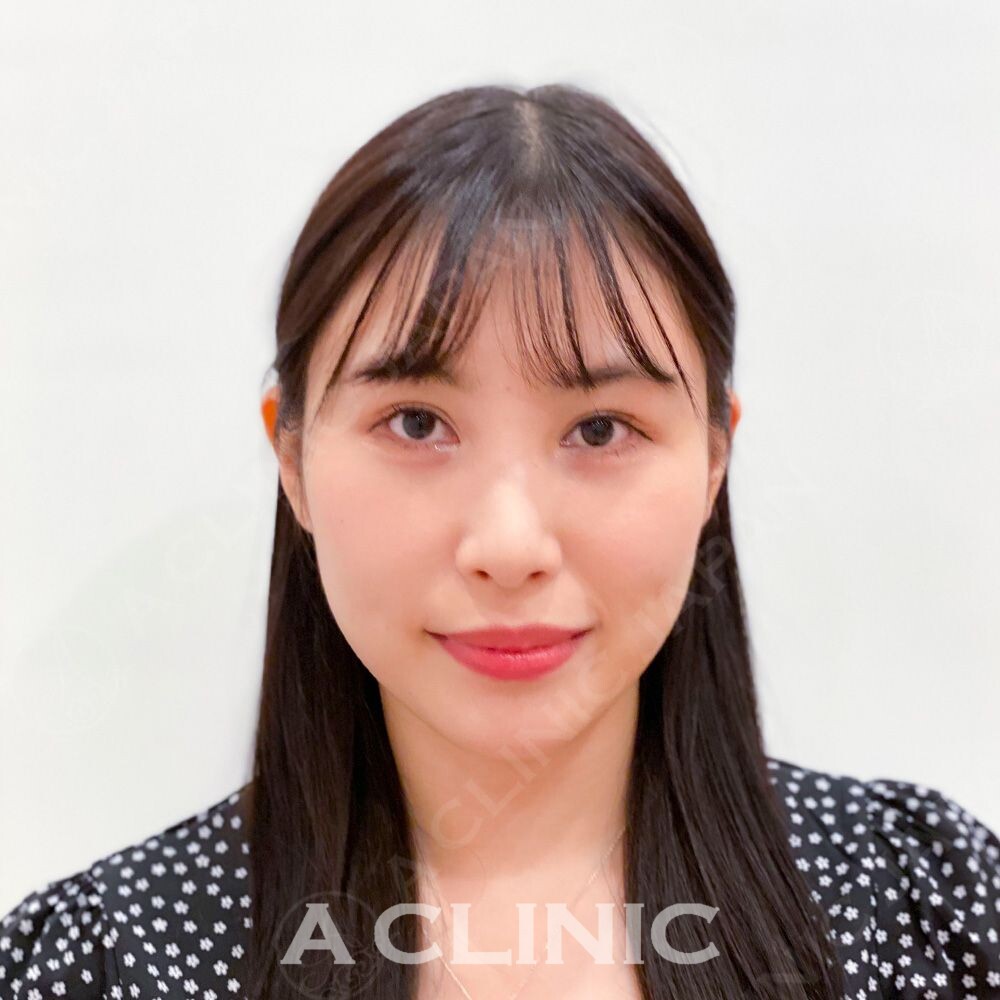 糸リフトは小顔専門クリニックにお任せ下さい！Aスレッドの処置前と処置直後の症例です(20代女性) BEFORE