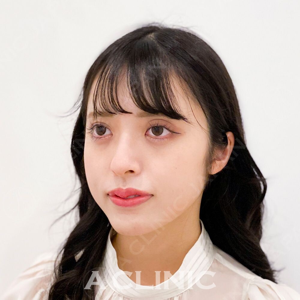 腫れがほぼなく即日小顔効果！Aスレッドの処置前と処置直後の症例です(20代女性) BEFORE