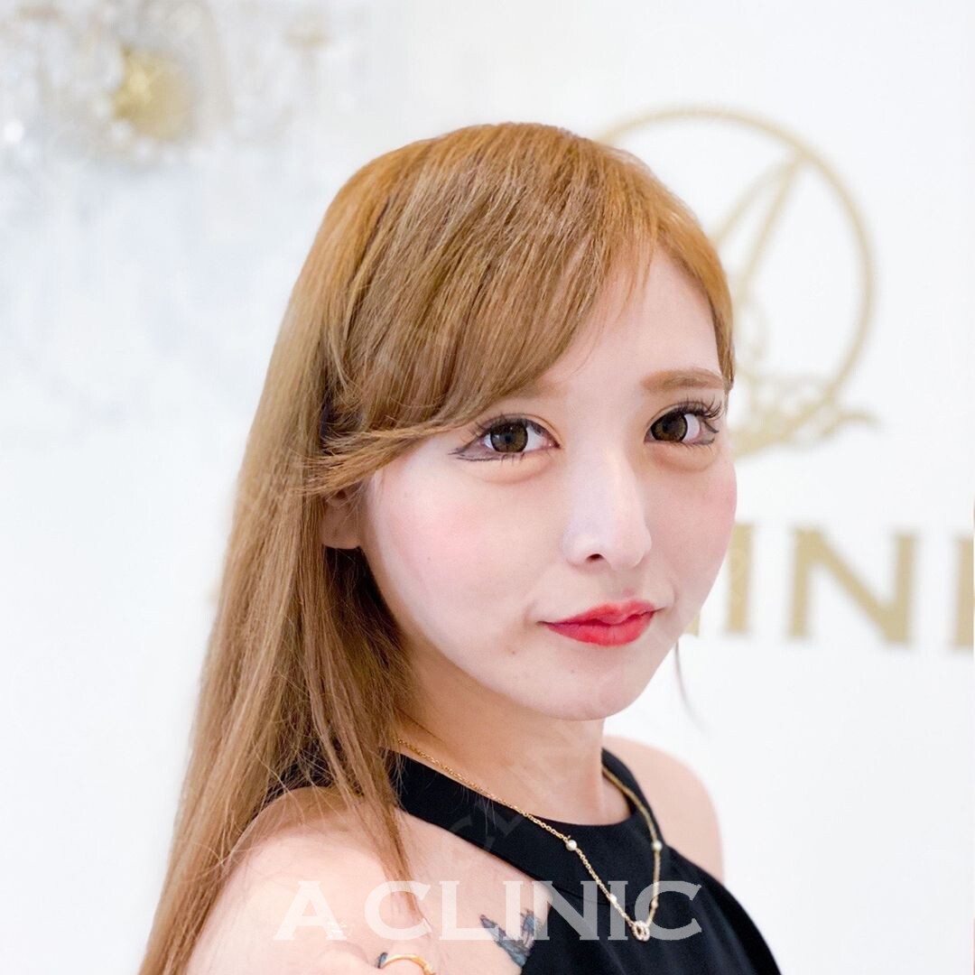 Aスレッドでその日のうちに小顔美人に！処置前と処置直後の症例写真です(20代女性) BEFORE