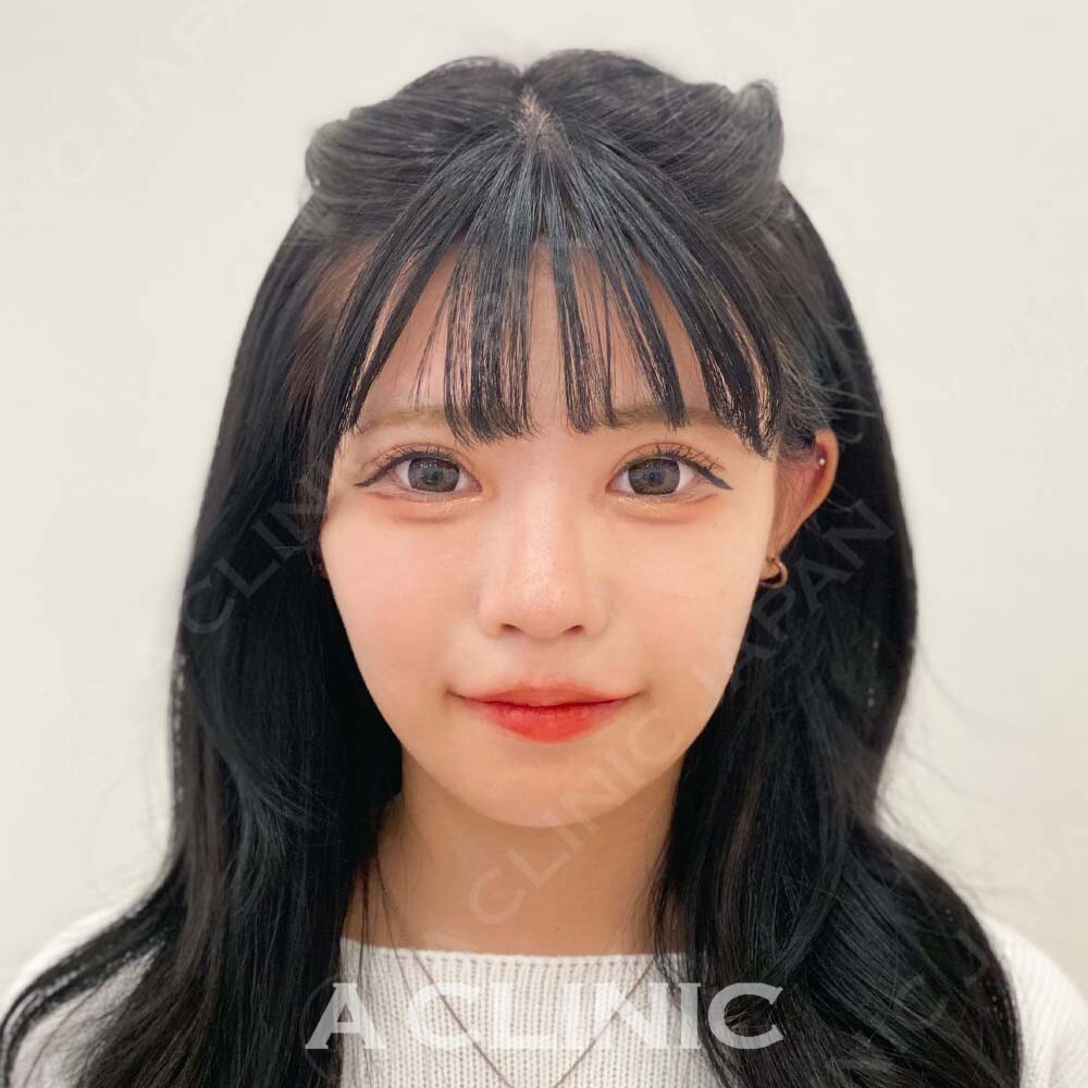 Aスレッドで口横のもたつきを即日解消！大人気施術の処置前と処置直後の症例です(10代女性) AFTER