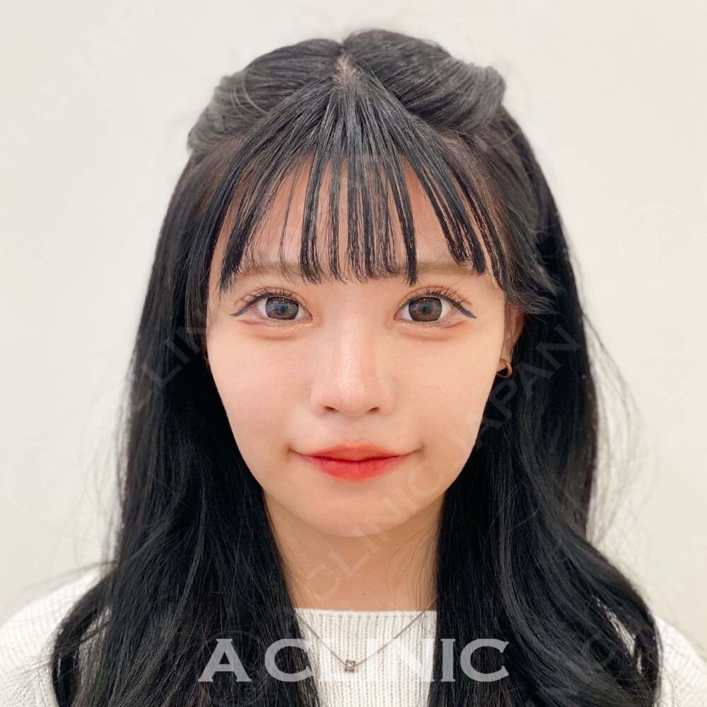 Aスレッドで口横のもたつきを即日解消！大人気施術の処置前と処置直後の症例です(10代女性) BEFORE