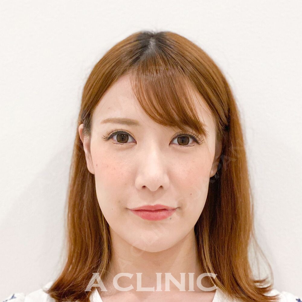 Aスレッドでフェイスラインのもたつきを改善するだけで若返った印象に！処置前と処置直後の症例です(30代女性) BEFORE