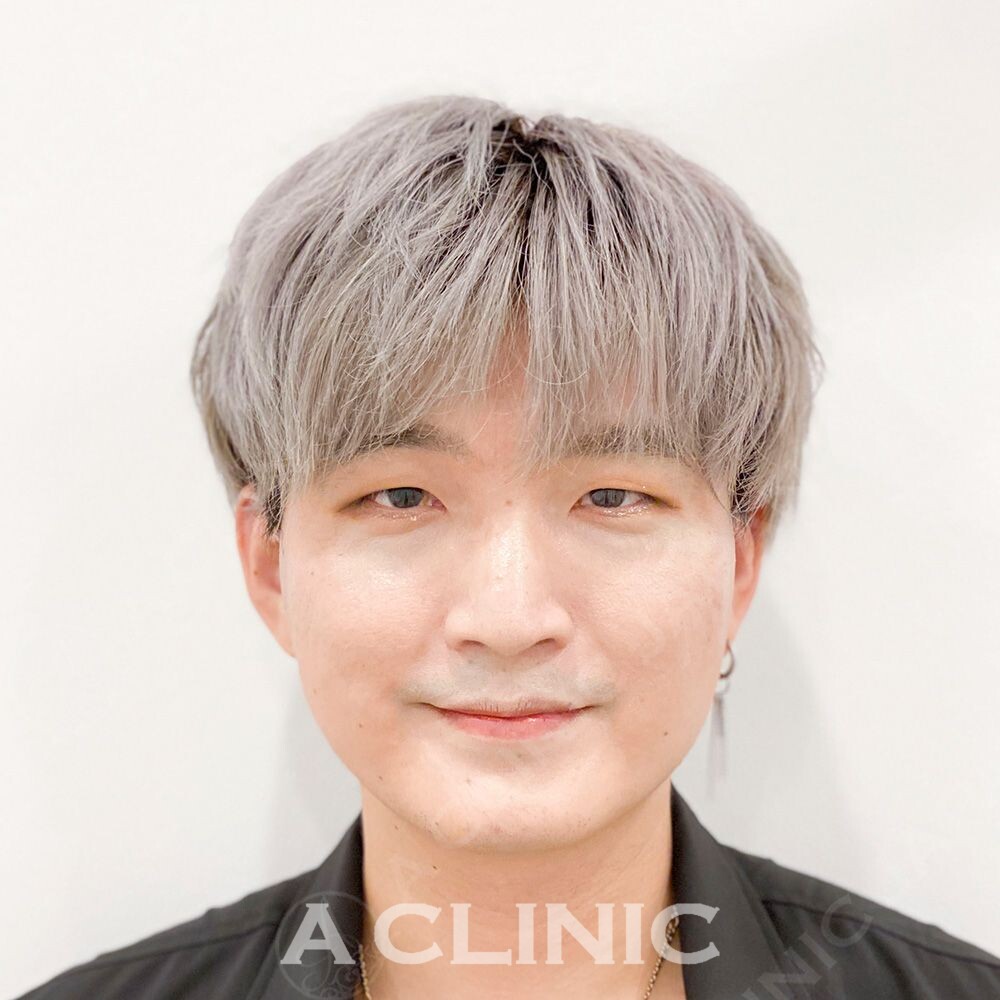 Aスレッドで直後からしっかり引き上げます！処置前と処置直後の症例です(30代男性) BEFORE