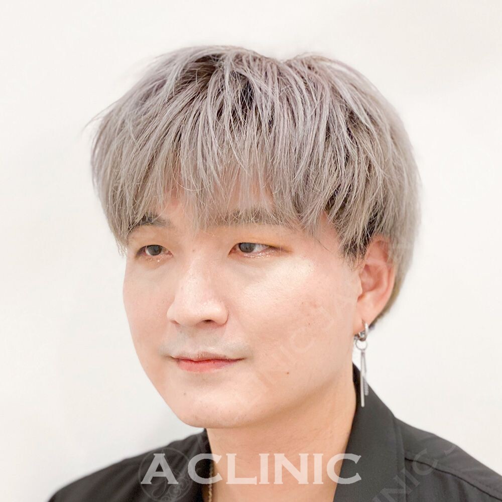 Aスレッドで瞬時に肌が引き上がる！将来的なたるみ予防にも！処置前と処置直後の症例です(30代男性) BEFORE