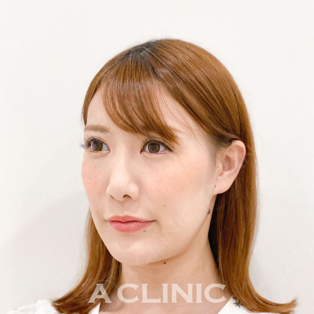 Aスレッドはたった15分で綺麗なVフェイスになれます！処置前と処置直後の症例です(30代女性) BEFORE