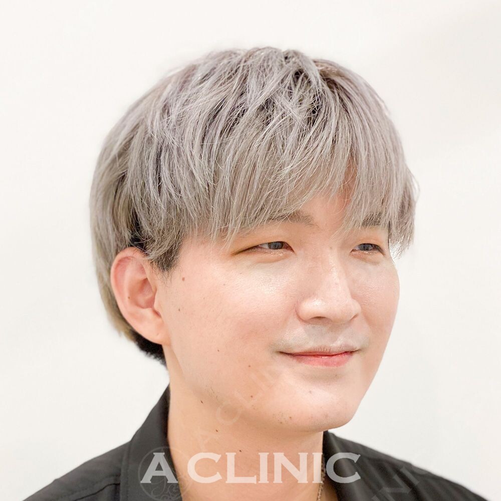 Aスレッドで15分で見た目が自然に若返ります！処置前と処置直後の症例です(30代男性) BEFORE