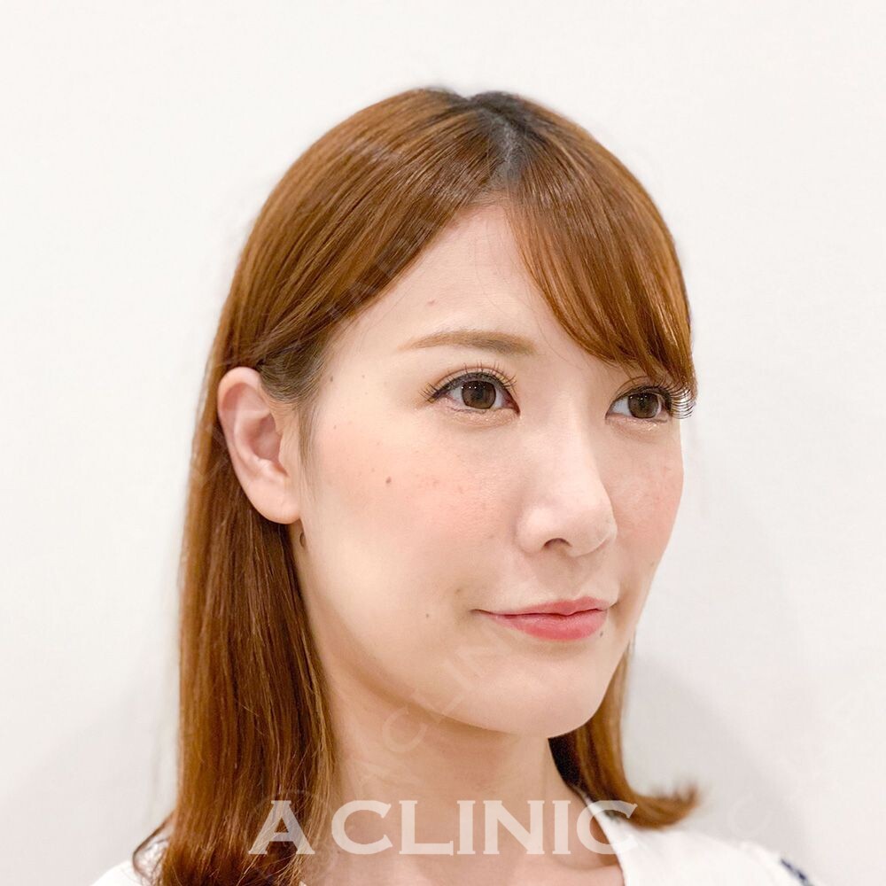 Aスレッドは少ない本数でもしっかり引き上がるんです！処置前と処置直後の症例です(30代女性) BEFORE