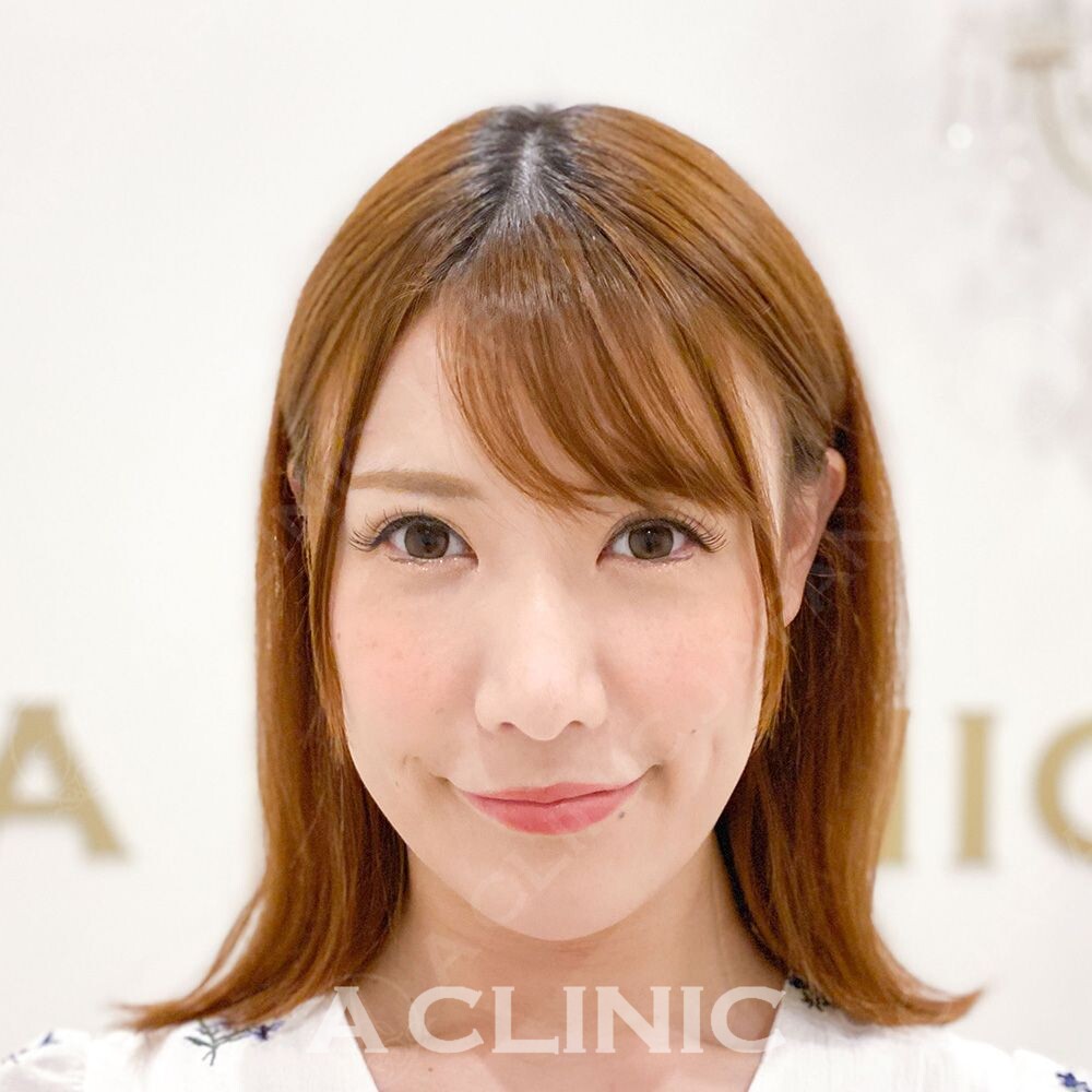 Aスレッドはたった15分でフェイスラインのたるみをしっかり引き上げます！処置前と処置直後の症例です(30代女性) BEFORE