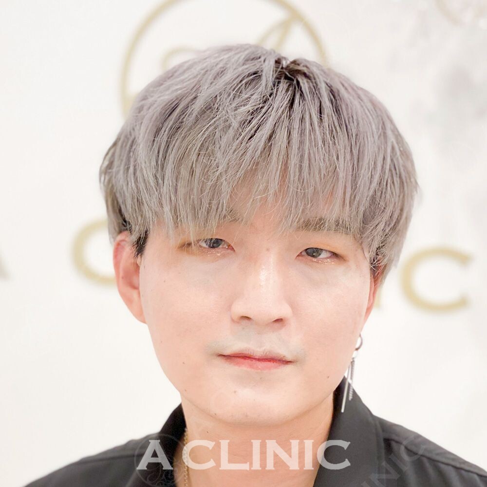 Aスレッドで直後から輪郭がハッキリとしました！処置前と処置直後の症例です(30代男性) BEFORE