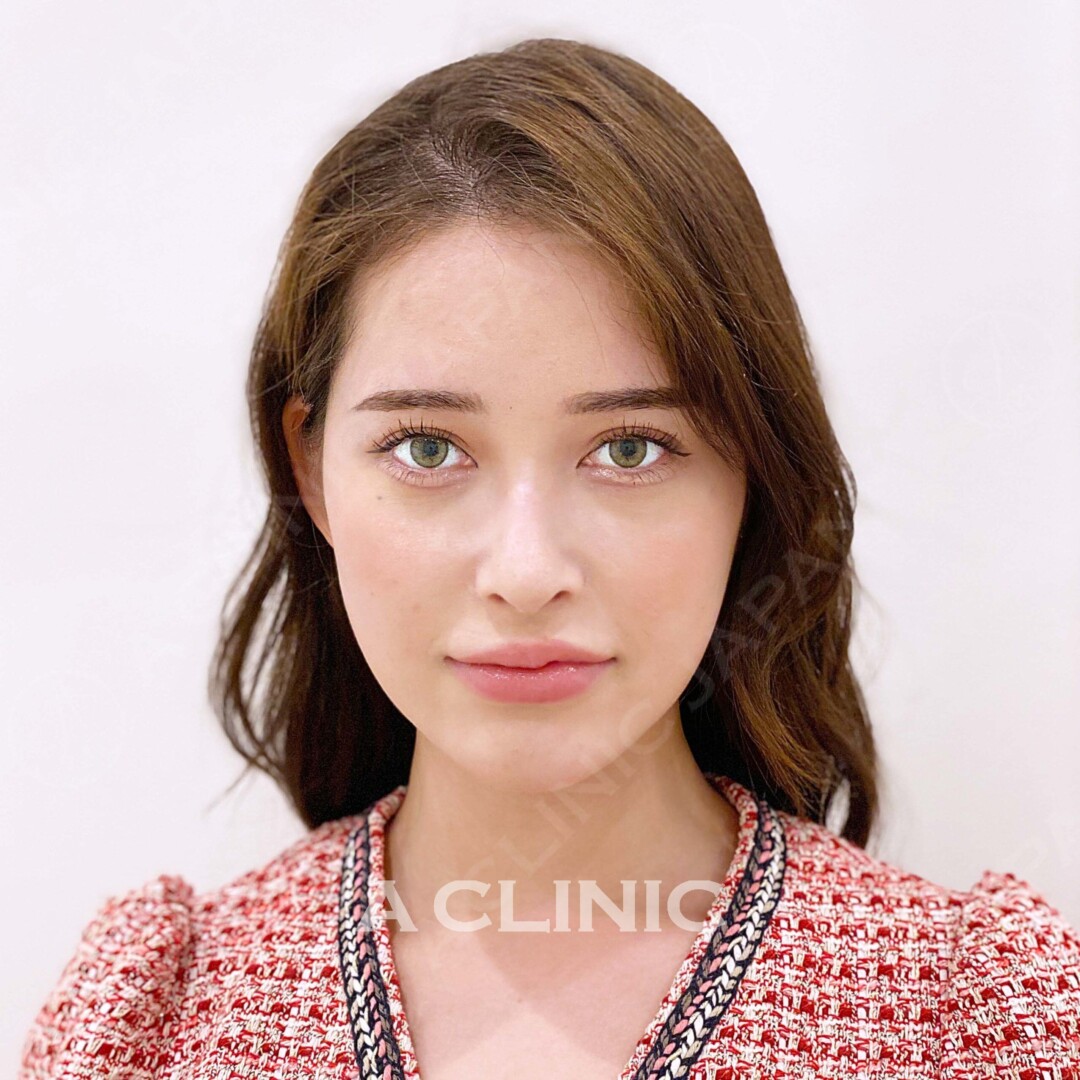 元々小顔の方でもしっかり引き上げ小顔に仕上がります！Aスレッドの処置前と処置直後の症例です(20代女性) BEFORE