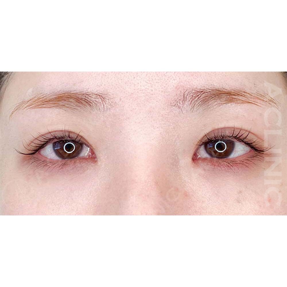 つり目が柔らかい印象に変わりました！パーフェクトアイズの処置前と2週間後の症例です(30代女性) BEFORE