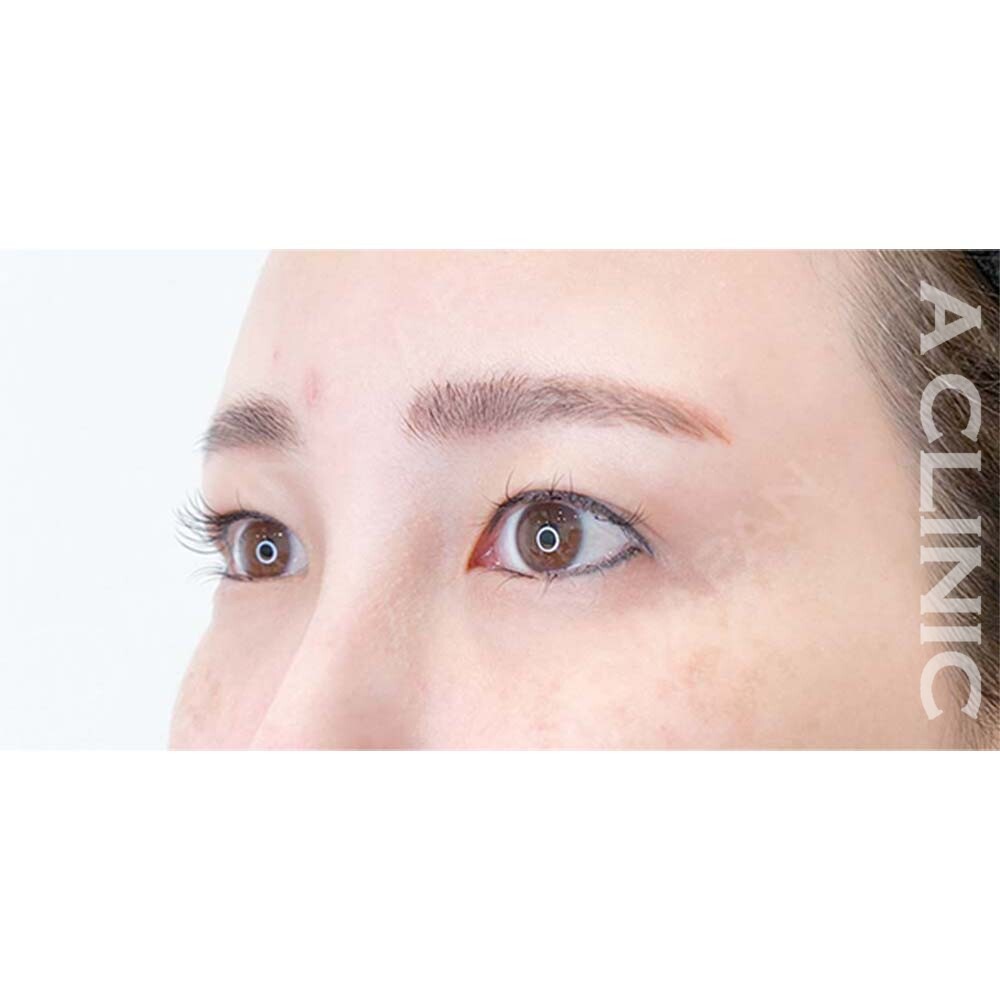 パーフェクトアイズでパーフェクトな理想のたれ目になりませんか？処置前と2週間後の症例です(40代女性) BEFORE