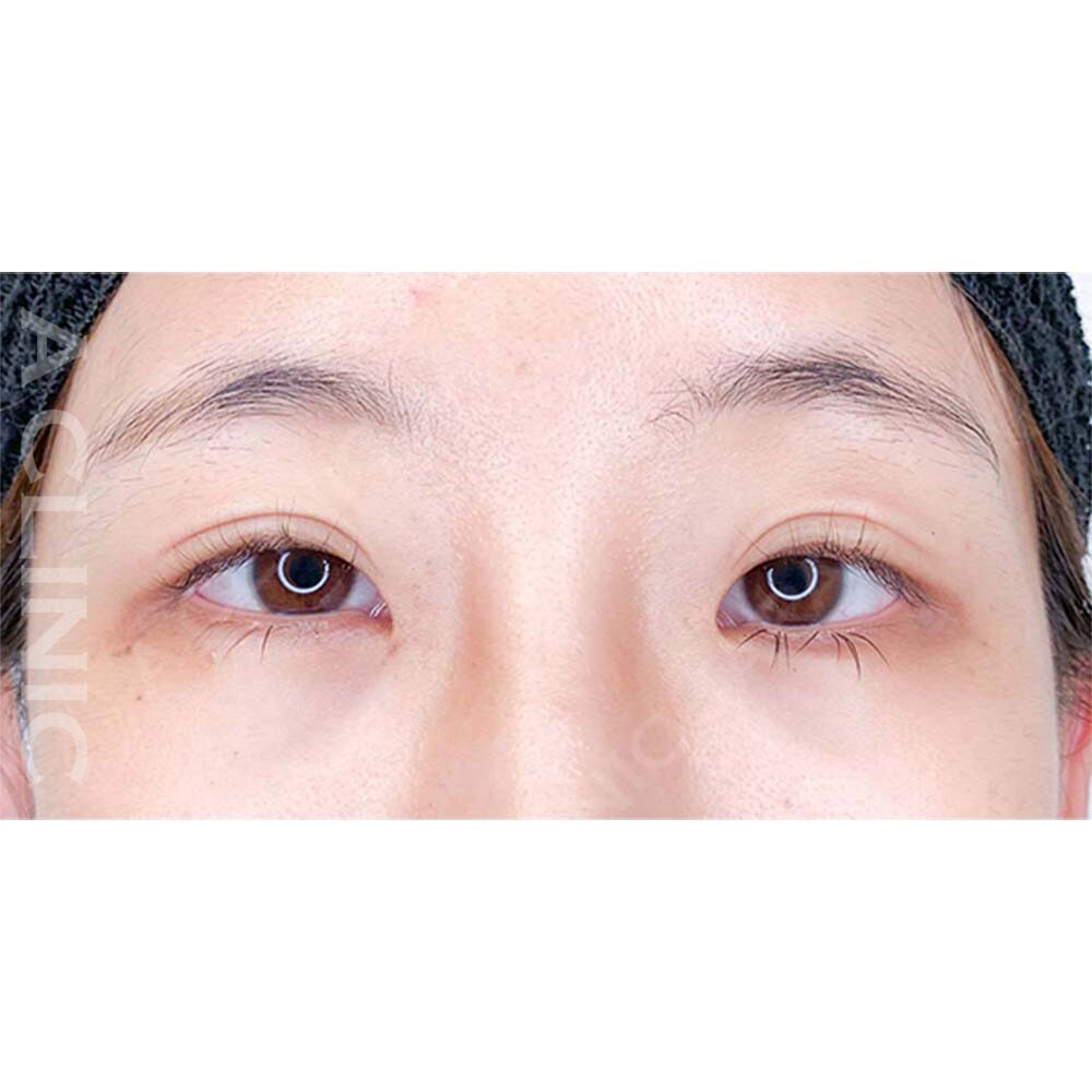 パーフェクトアイズでパッチリした目元になりました！処置前と2週間後の症例です(20代女性) BEFORE