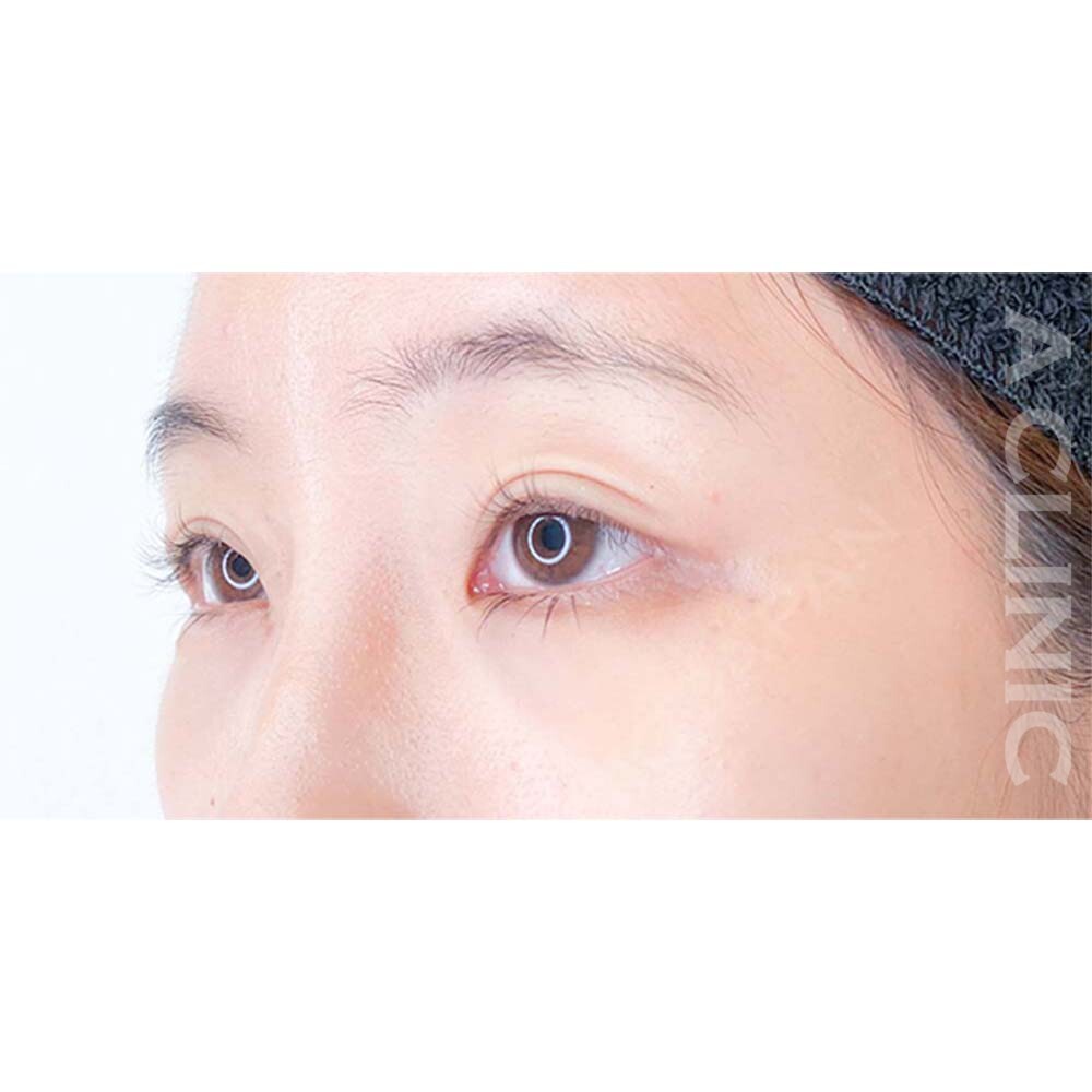 パーフェクトアイズでかわいい印象になりたいあなたへ！処置前と2週間後の症例です(20代女性) BEFORE