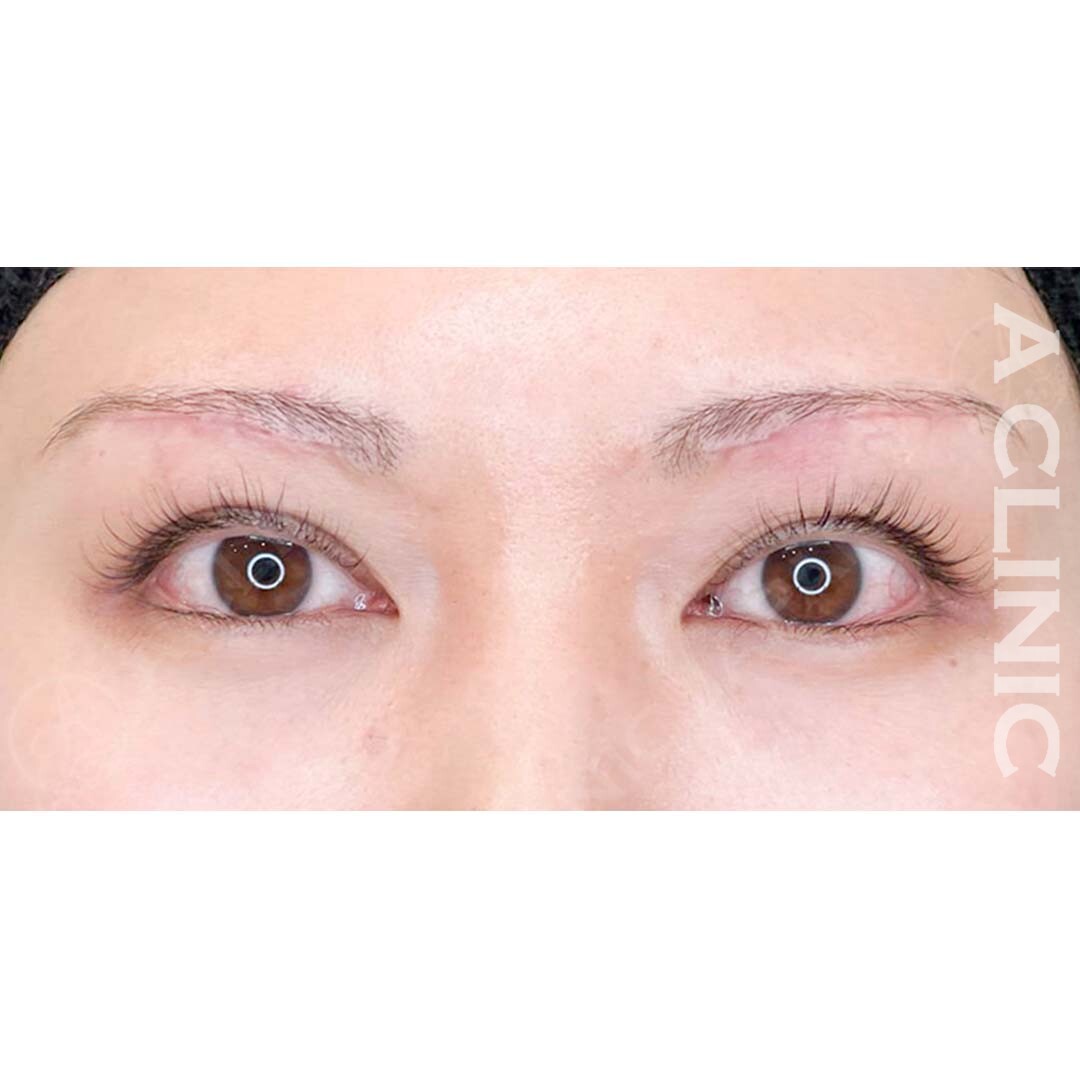 重たい目元を解消する眉下リフト！処置前と処置1ヶ月後の症例です(30代女性) AFTER