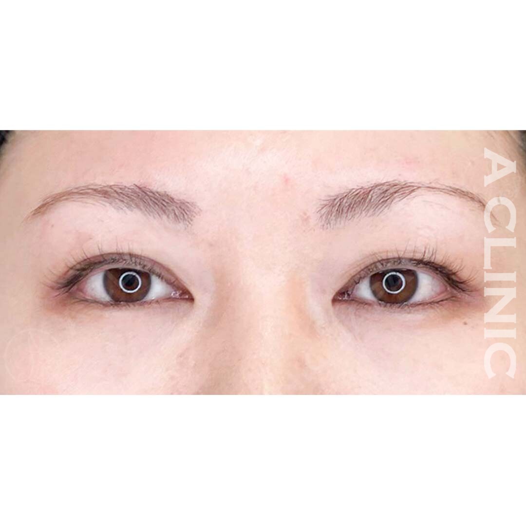 重たい目元を解消する眉下リフト！処置前と処置1ヶ月後の症例です(30代女性) BEFORE