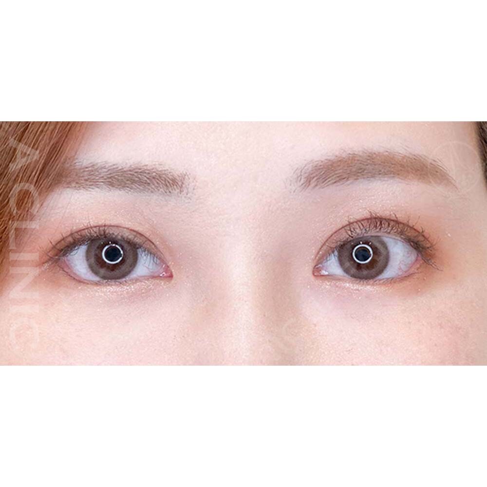 パーフェクトアイズで自然に大きい目元になりました！処置前と2週間後の症例です(30代女性) AFTER