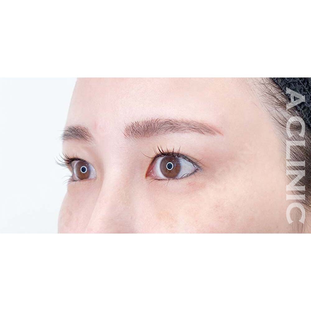 パーフェクトアイズでパーフェクトな理想のたれ目になりませんか？処置前と2週間後の症例です(40代女性) AFTER