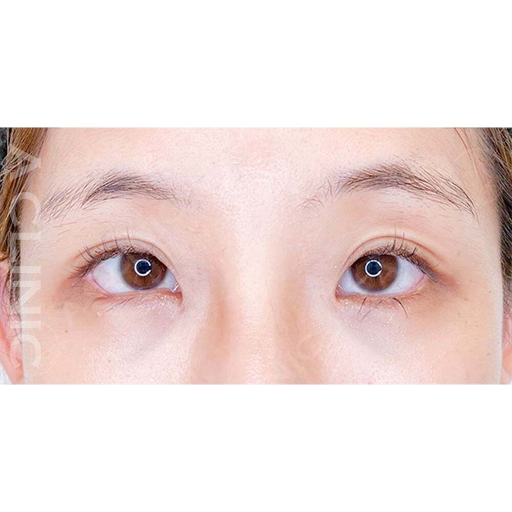 パーフェクトアイズでパッチリした目元になりました！処置前と2週間後の症例です(20代女性) AFTER