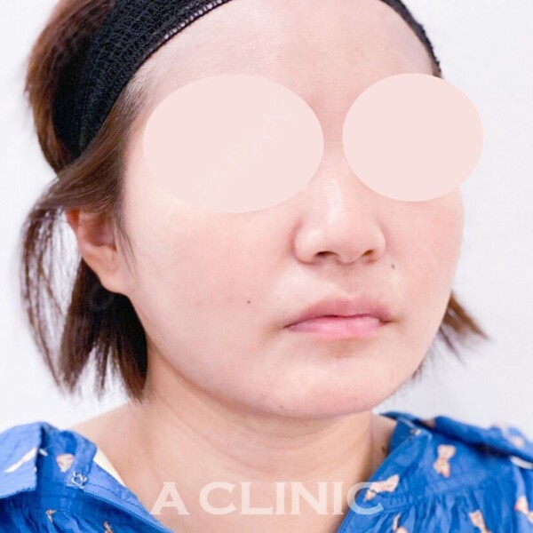 1day脂肪吸引であっという間に綺麗なフェイスラインに！処置前と1ヶ月後の症例です(20代女性) AFTER