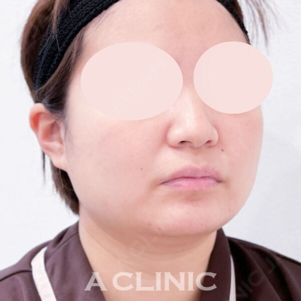 1day脂肪吸引であっという間に綺麗なフェイスラインに！処置前と1ヶ月後の症例です(20代女性) BEFORE