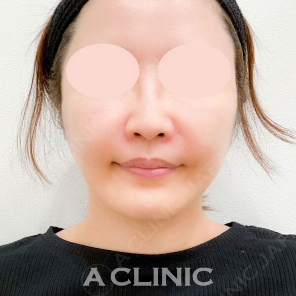 Aスレッドは小顔効果に加えシワやタルミなどのお悩みも解消します！処置前と施術直後の症例です(40代女性) AFTER