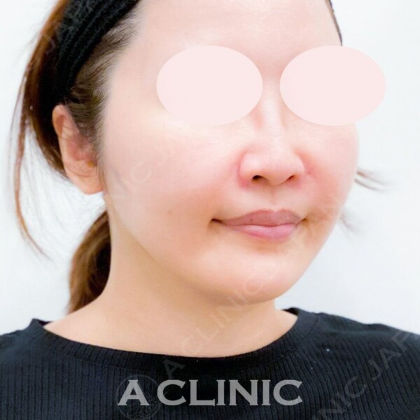 Aスレッドは直後からリフトアップ効果を実感できます！処置前と施術直後の症例です(40代女性) AFTER