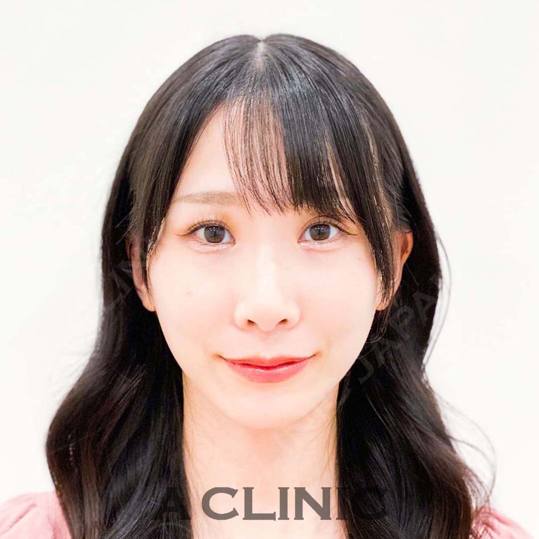 Aスレッドで劇的にフェイスラインがスッキリ小顔に！施術前と施術直後の症例です(20代女性) AFTER