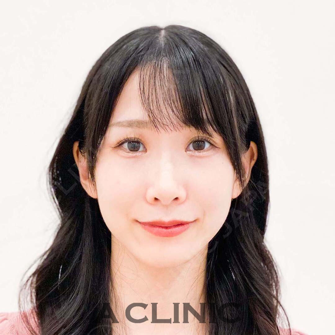 Aスレッドで劇的にフェイスラインがスッキリ小顔に！施術前と施術直後の症例です(20代女性) BEFORE