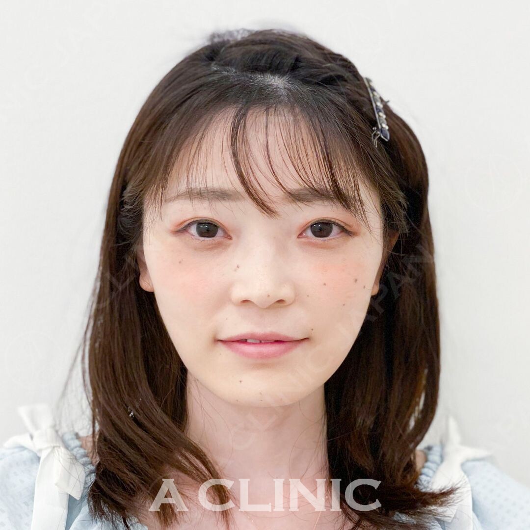 小顔Aスレッドで即日顔痩せ！こちら処置前と処置直後の症例写真です(30代女性) AFTER