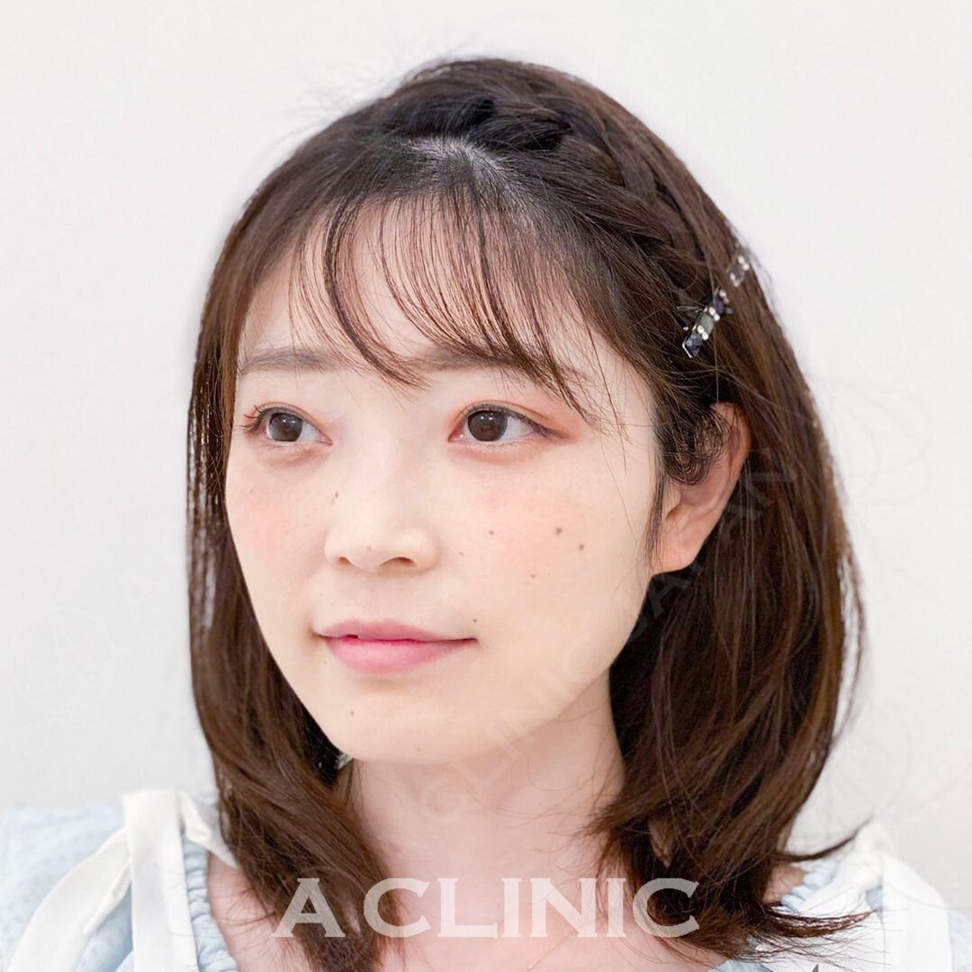 その日から引き締まった小顔に変化！Aスレッド処置前と処置直後の症例写真です(30代女性) AFTER