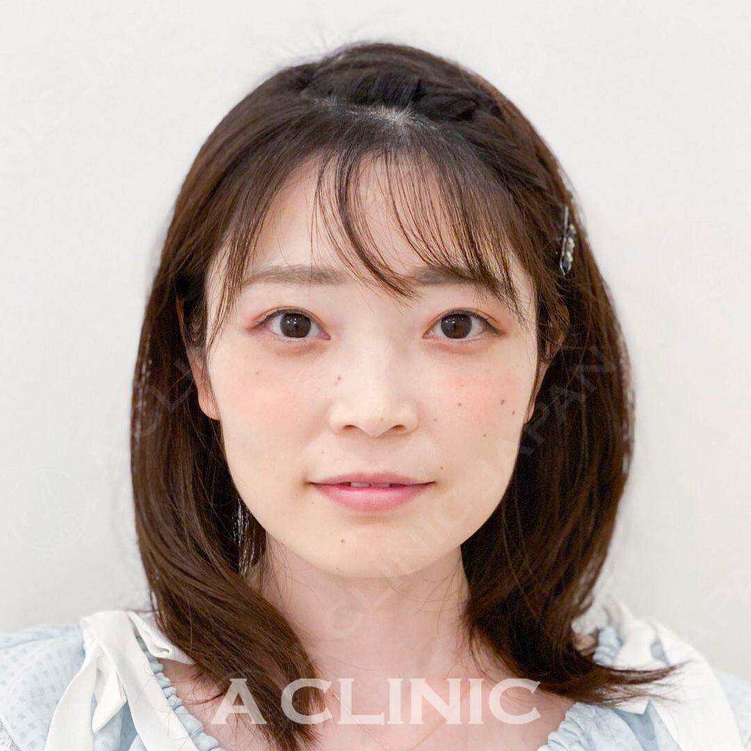 小顔Aスレッドで即日顔痩せ！こちら処置前と処置直後の症例写真です(30代女性) BEFORE