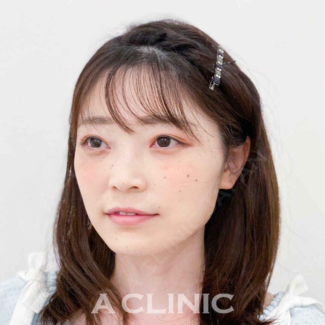 その日から引き締まった小顔に変化！Aスレッド処置前と処置直後の症例写真です(30代女性) BEFORE