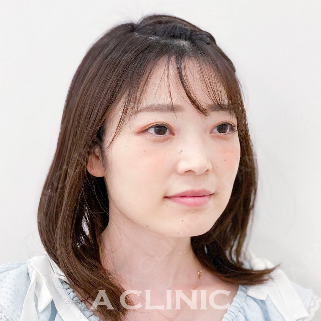 もたつきが横に広がっていると顔が大きく見える原因に！Aスレッドで即日解消しませんか。こちら処置前と処置直後の症例です(30代女性) BEFORE