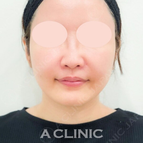 Aスレッドは小顔効果に加えシワやタルミなどのお悩みも解消します！処置前と施術直後の症例です(40代女性) BEFORE