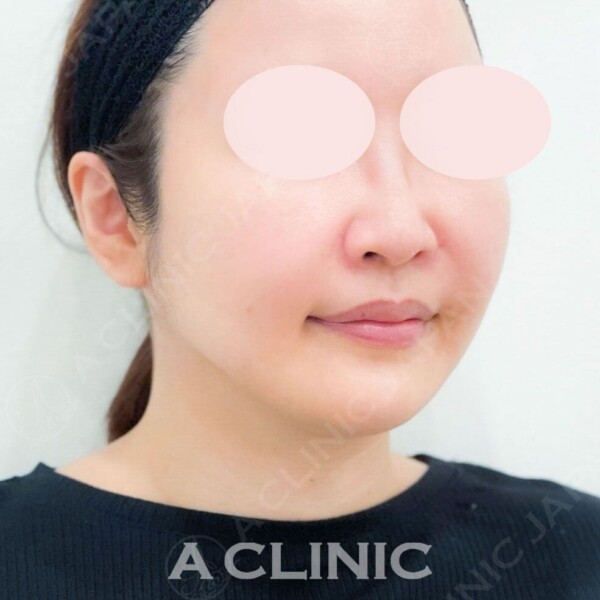 Aスレッドは直後からリフトアップ効果を実感できます！処置前と施術直後の症例です(40代女性) BEFORE