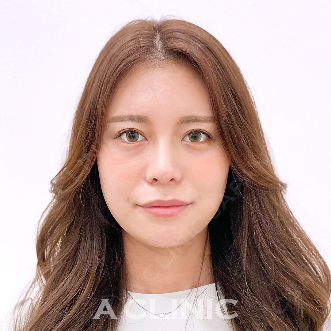 左右差のあるフェイスラインもAスレッドなら綺麗に整います！処置前と処置直後の症例です(30代女性) AFTER