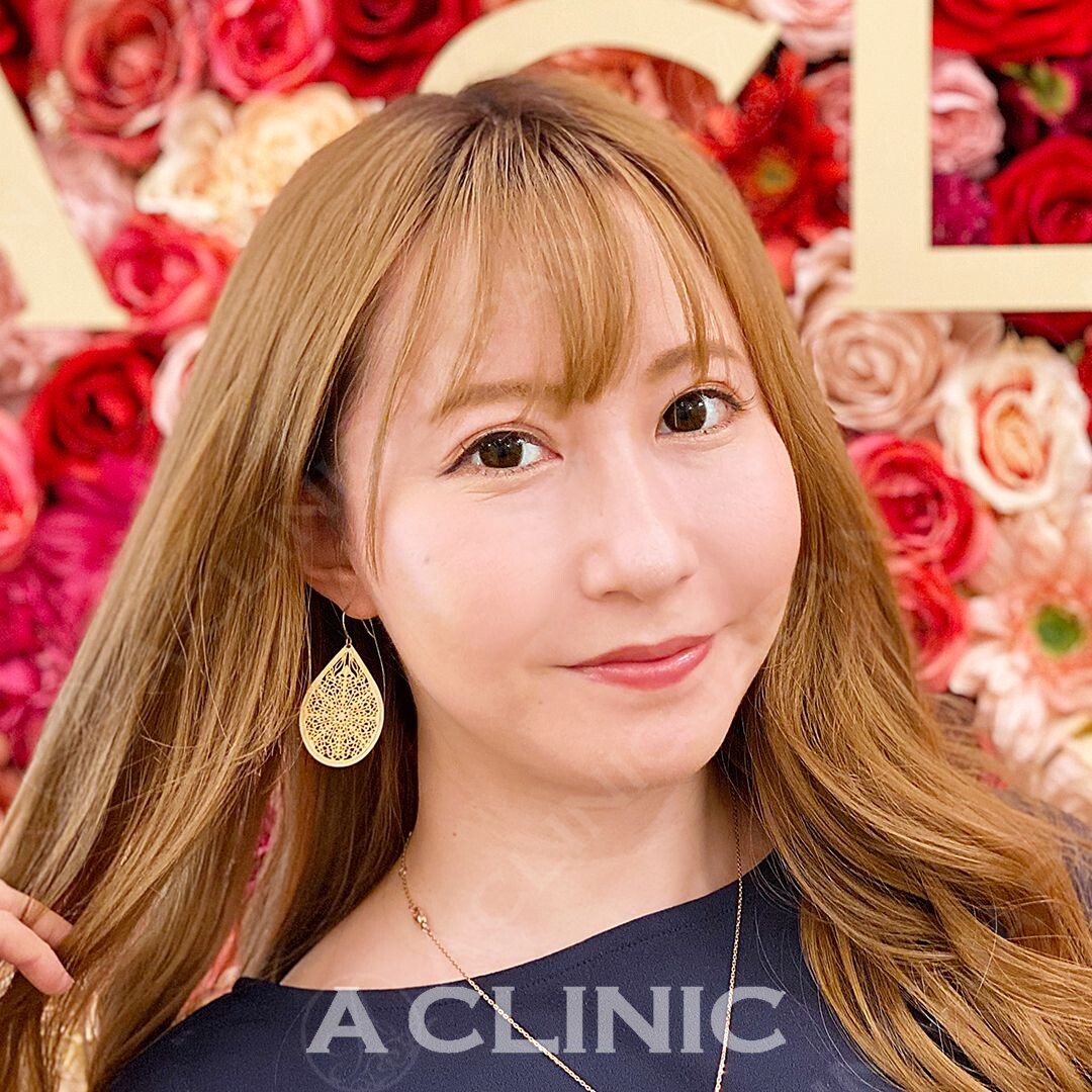 ダイエットをせずに顔痩せが叶う小顔Aスレッド！処置前と処置直後の症例写真です(30代女性) AFTER