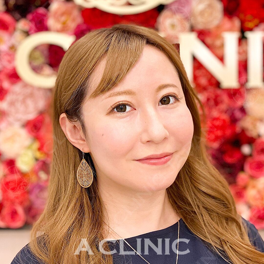 ダイエットをせずに顔痩せが叶う小顔Aスレッド！処置前と処置直後の症例写真です(30代女性) BEFORE