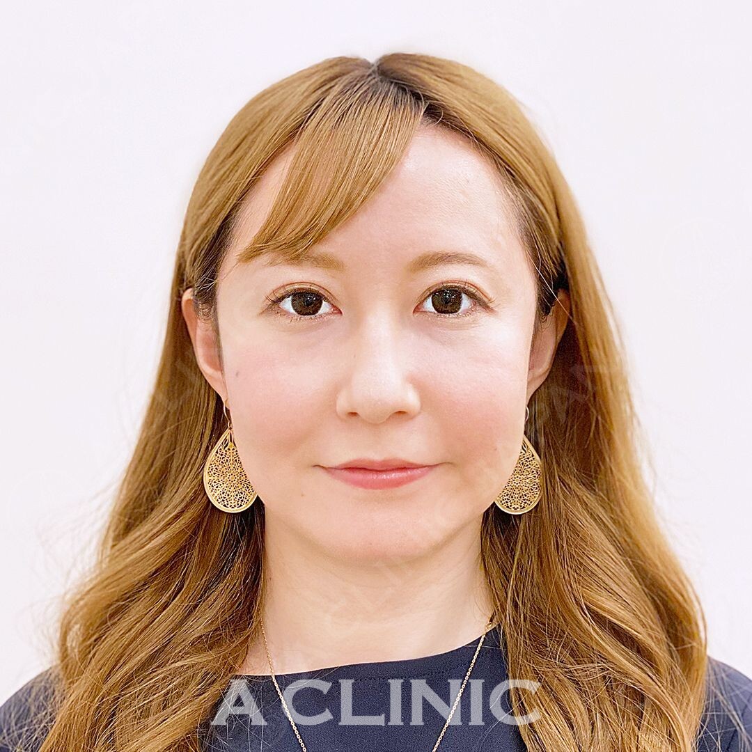 衝撃の小顔体験をAクリニックでしませんか？小顔Aスレッドの処置前と直後の症例写真です(30代女性) BEFORE