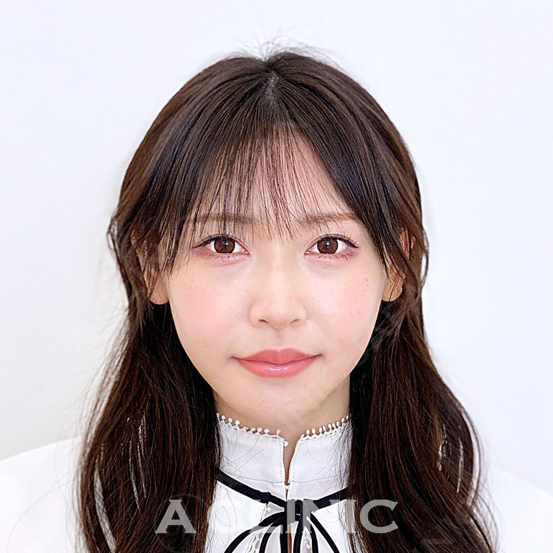 Aスレッドで小顔になりさらに可愛く愛されフェイスに！処置前と処置直後の症例です(20代女性) AFTER